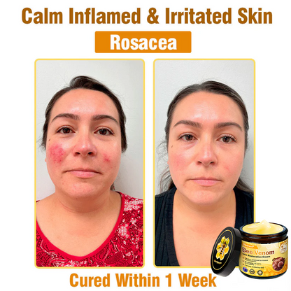 ✨Ourlyard® Bee Venom Skin Restoration Cream — 🔥Limited Time 80% OFF🔥