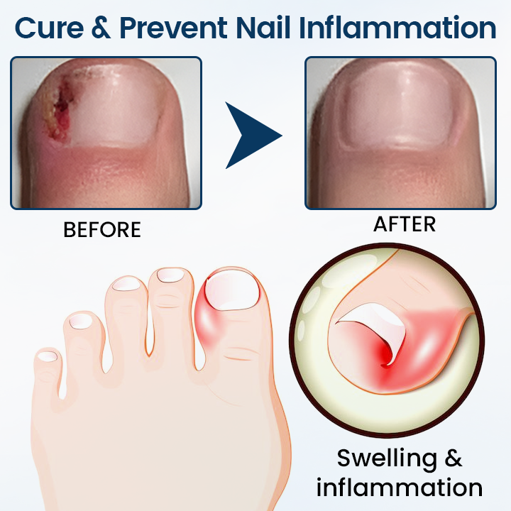 🎀Ourlyard® NailGuard Fungal Repair Herbal Spray